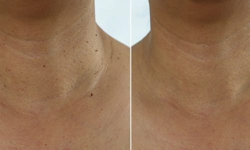 SHEILA-SKIN-CARE-Remoción-de-Skin-Tags-(Acrocordones)